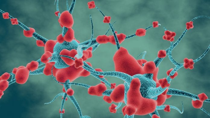 В Японии нашли новый метод лечения болезни Альцгеймера