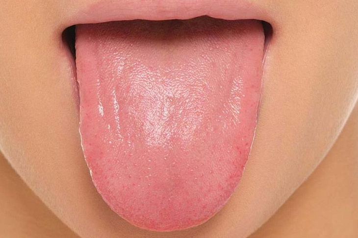 Медики рассказали, как определить COVID-19 по языку