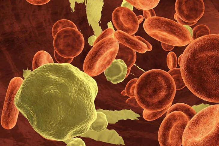 Врачи определили внешние симптомы повышенного холестерина