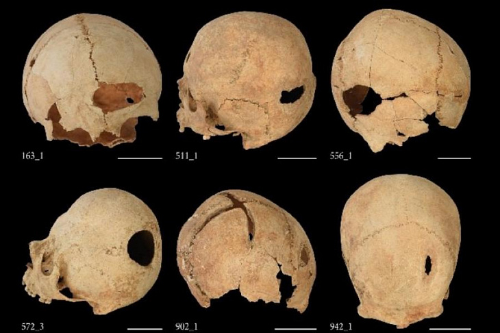 Стало известно, зачем в Средневековье проводили трепанацию