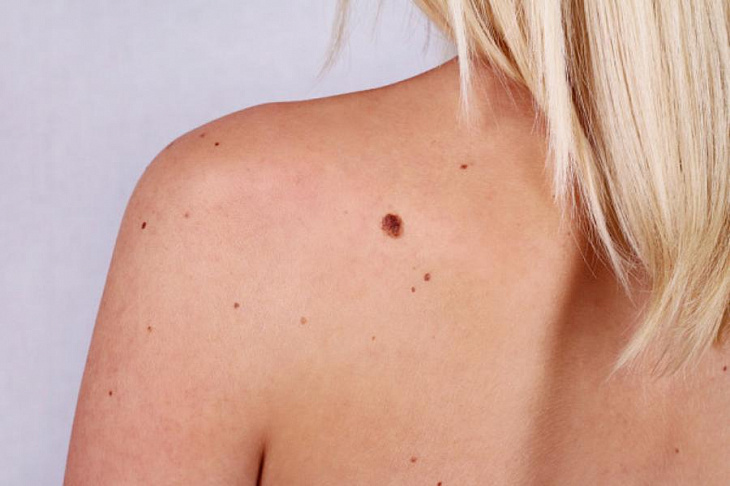 Онколог опровергла миф о связи рака и травмы родинки