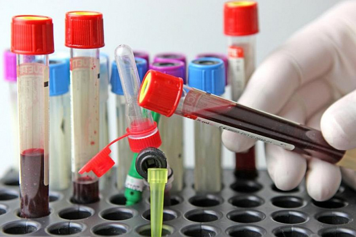 Найдена вторая пациентка, самостоятельно избавившаяся от ВИЧ