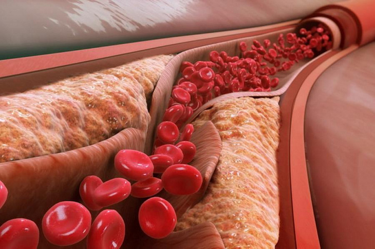 Исследователи поняли, как предотвратить атеросклероз сосудов