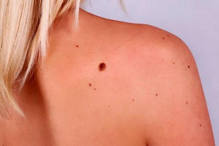 Британские медики раскрыли первые признаки рака кожи