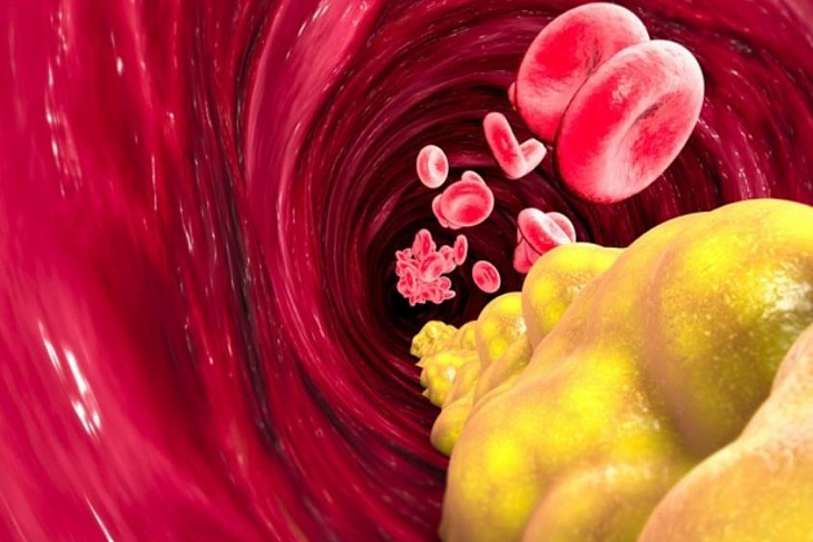 Что, кроме продуктов, негативно сказывается на холестерине